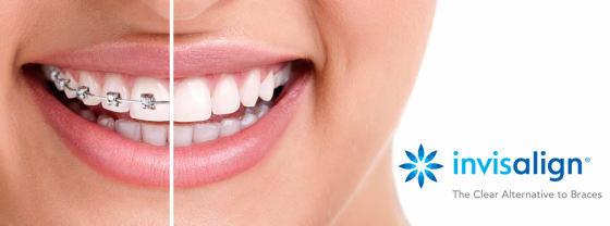 Invisalign