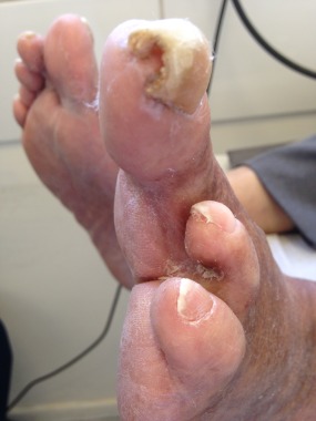 Paciente amputado (pie diabetico)