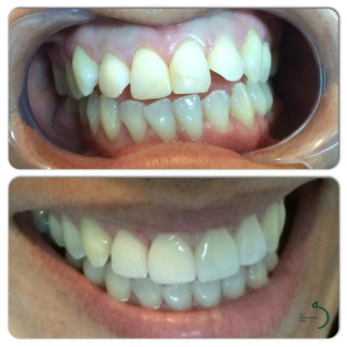 Veneers
