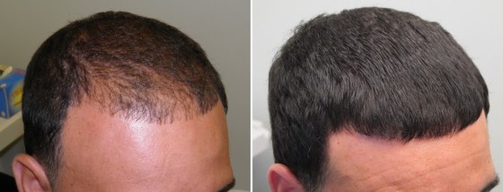 HAIR LOSS TREATMENT