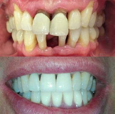 Fotografía superior muestra estado inicial post destartraje supra y subgingival.  En fotografía inferior se muestra tratamiento finalizado, donde se realizaron PFU en sector anterior superior, ademas de protesis parcial removible superior e inferior.