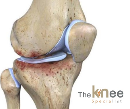 Experto desgaste rodilla