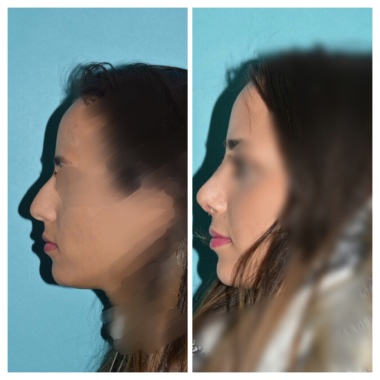 Féminisation par Rhinoplastie