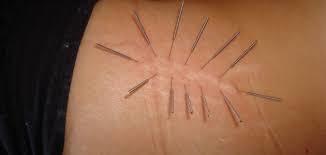 Tratamento para Estrias