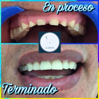 Coronas E-max