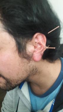 Tratamiento para control de stres