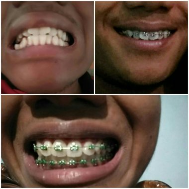 Perubahan setelah pemasangan kawat gigi