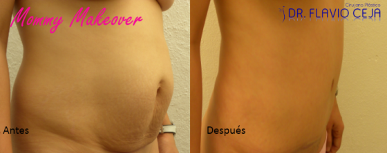 Abdominoplastia