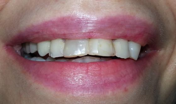 caz 5 inainte hollywood smile coroane din zirconiu