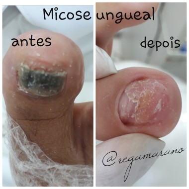 Micose unguel