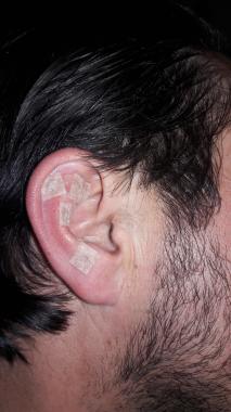 Tratamiento para control del dolor, articulaciones