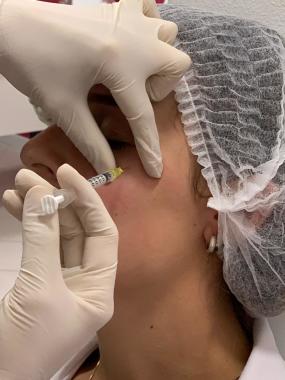 Aplicação de botox no famoso pé de galinha