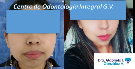 Bichectomía/ Lipectomía facial