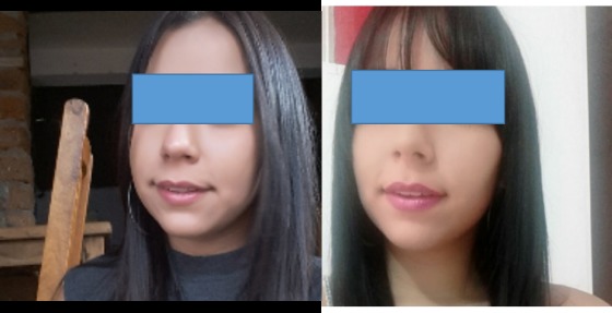 Bichectomía/lipectomía facial