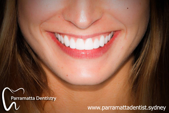 Dental_veneer.jpg
