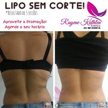 Lipo sem Corte- 5 sessões