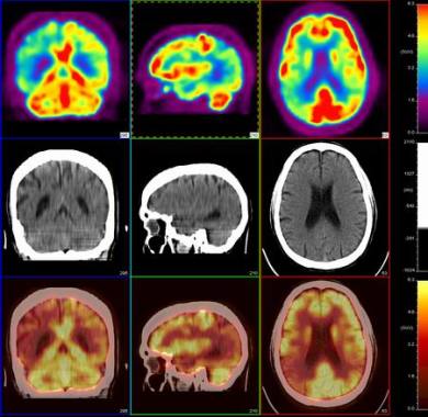 Nutrición y Trastornos Metabólicos & Neurológicos Graves