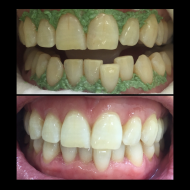 Blanqueamiento dental