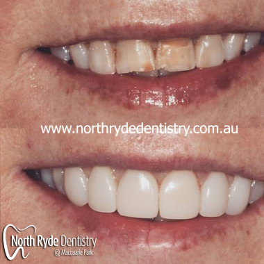 North_Ryde_composite_veneer.jpg