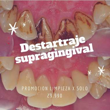 Limpieza Dental