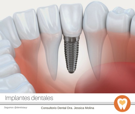 Consultanos por nuestro servicio de Implantes. Agil, rápido y con tecnología de vanguardia.  Reserva tu consulta 4225 5106 #dentistauy