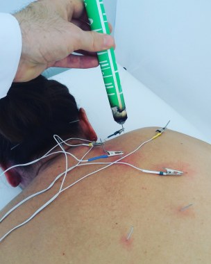 Eletroacupuntura para dores.