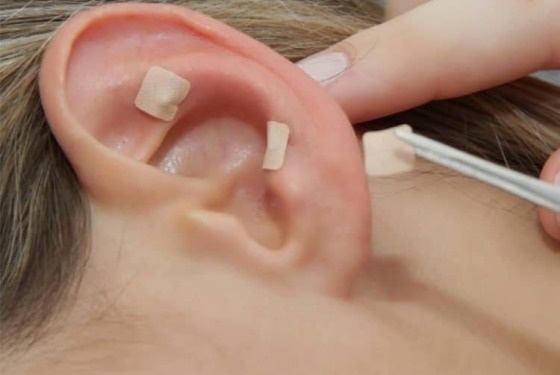 Auriculoterapia para tratar lombalgia