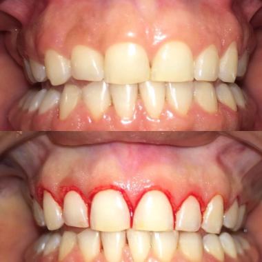 La gingivectomia es un tratamiento quirúrgico  mediante el cual se realiza la escisión y supresión del tejido gingival lesionado. Por lo que es importante que el paciente esté informado de los objetivos a perseguir y de las limitaciones de la técnica. Mediante una minuciosa evaluación de su situación bucal, un buen diagnóstico y un correcto plan de tratamiento.