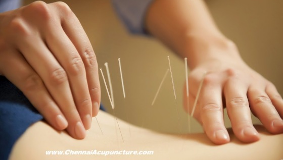 Acupuncture Treatment in Chennai