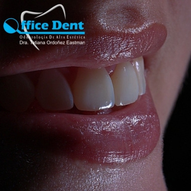 Diseño Estetico Dental