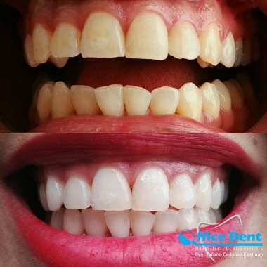 Aclaramiento Dental