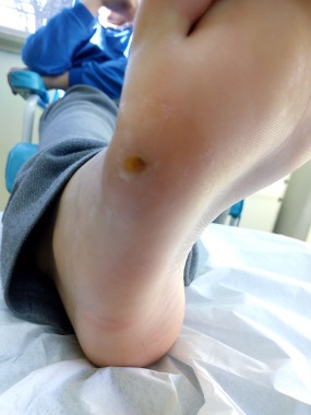 Tratamiento para verruga plantar