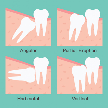 wisdom-teeth-problems.jpg
