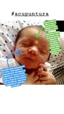Você sabia que bebês podem fazer acupuntura?