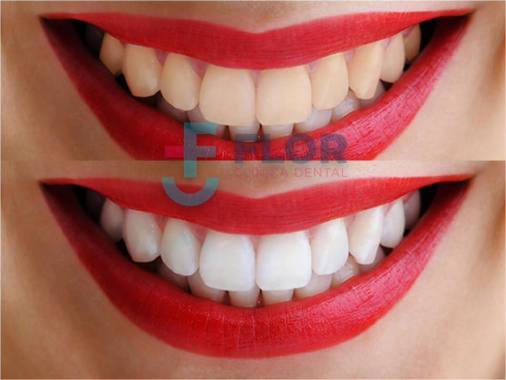 NECESITAS BLANQUEAMIENTO DENTAL? Llamanos ahora mismo !!!