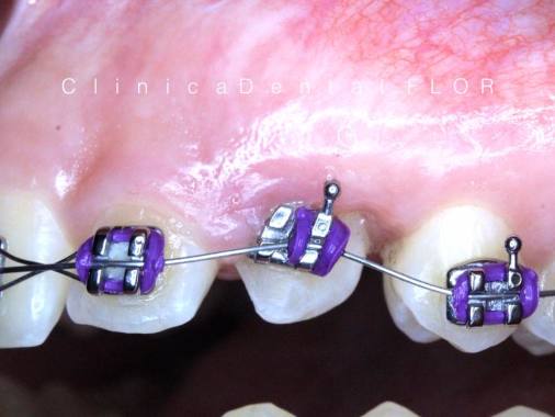 ORTODONCIA VESTIBULAR METALICA
