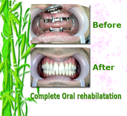 Complete Oral rehabilatation