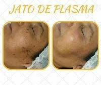 Jato de Plasma
