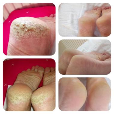Claus Peel Treatment Before and After