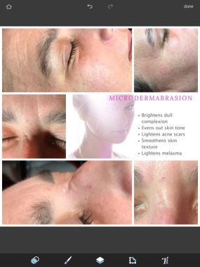 Microdermabrasion Treatment Before and After
