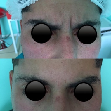 Toxina botulínica entrecejo