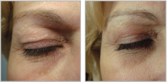 Ooglidcorrectie plasma Soft surgery