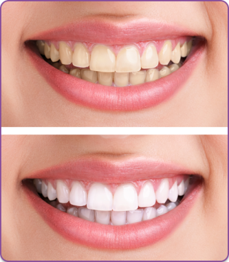 BLANQUEAMIENTO DENTAL