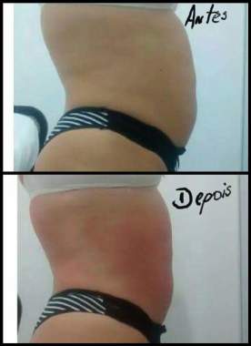 Reduza medidas!! Tratamentos personalizados!