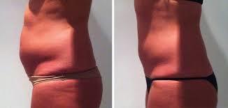 Coolsculpting