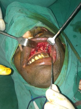 Maxillary fracture