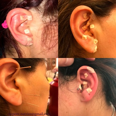 Tratamiento Auriculoterapia 