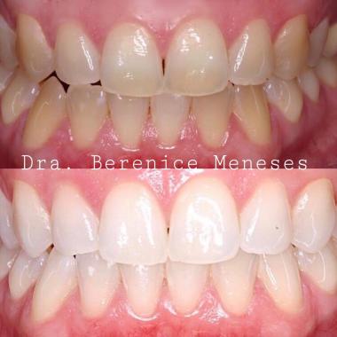 Aclaramiento dental 