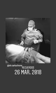 Abdominoplastia 