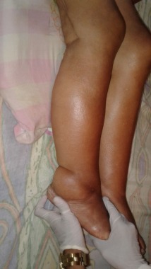 Edema.